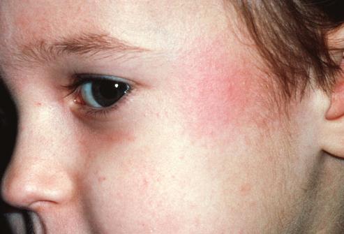 Utslett i ansiktet av barn: årsakene til utseendet