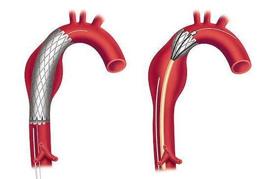 Aneurysme i abdominal aorta: symptomer, diagnose, behandling