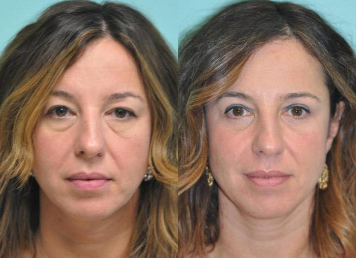 blepharoplasty nedre øyelokk i Moskva 