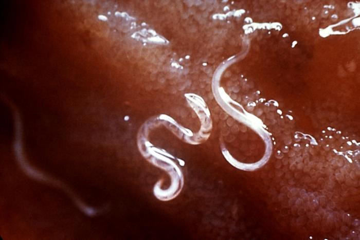 dirofilariasis hos mennesker