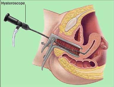 hysteroskopi av livmoren