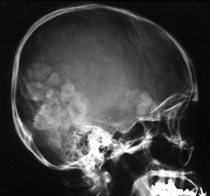 paragonimiasis forebygging