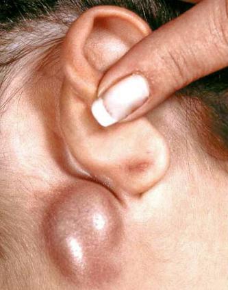 Hvorfor ble lymfeknuterne betent bak ørene?