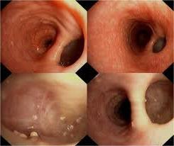 esophageal cancer symptomer bilder